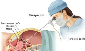 How is the removal of the uterus by laparoscopic method?
