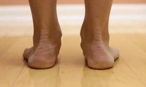 Vrodená PEC a plochá valgózna noha